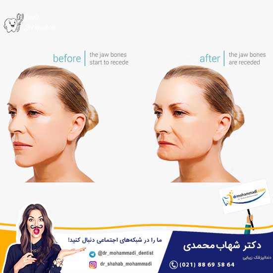 تحلیل استخوان چیست و چه رابطه ای با ایمپلنت دندان دارد؟ - کلینیک دندانپزشکی دکتر شهاب محمدی
